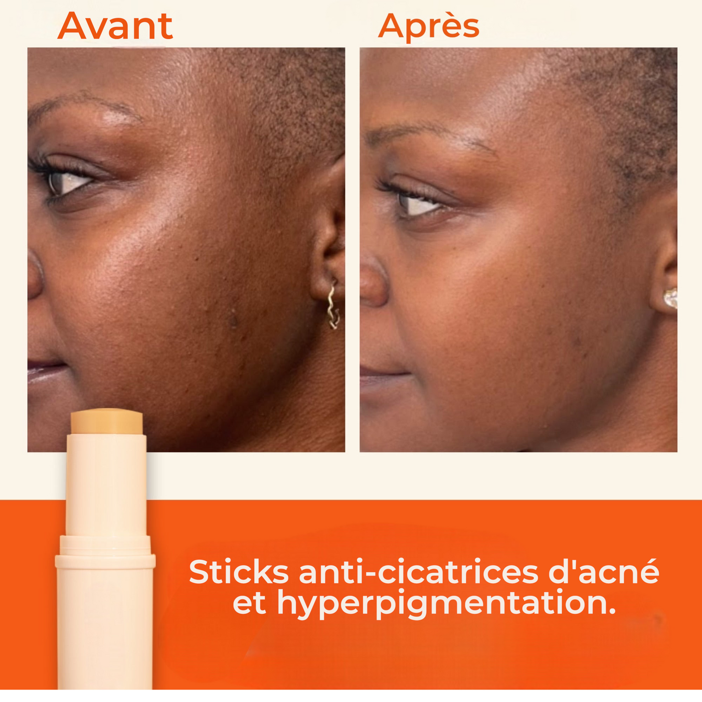 stick anti acne